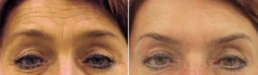 Le rajeunissement du champ du front