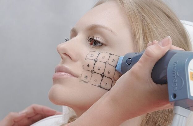 Procédure de thermage